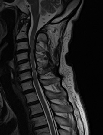 頚椎症性脊髄症MRI（写真１）