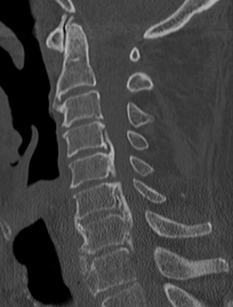 頚椎後縦靭帯骨化症CT（写真２）