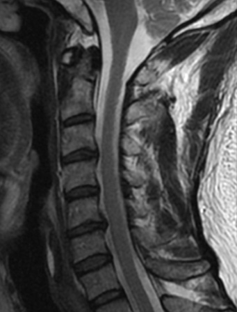 頚椎椎間板ヘルニアMRI（写真４）