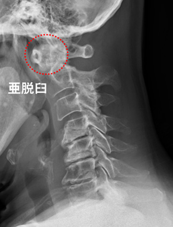 環軸椎亜脱臼レントゲン（写真７）