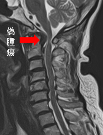歯突起後方偽腫瘍MRI（写真８）