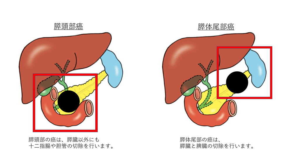 肝胆膵（膵臓）