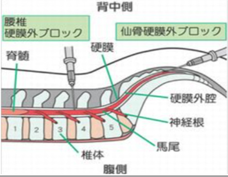 腰椎硬膜外ブロック　仙骨硬膜外ブロック（写真13）
