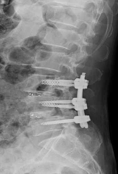 腰部脊柱管狭窄症に対する腰椎後方椎体固定術（TLIF）（写真14）術後