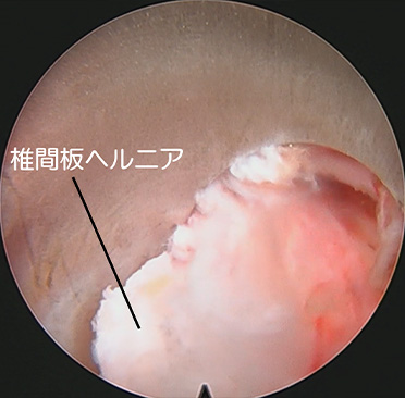 腰椎椎間板ヘルニア に対するFED（写真18）内視鏡画像