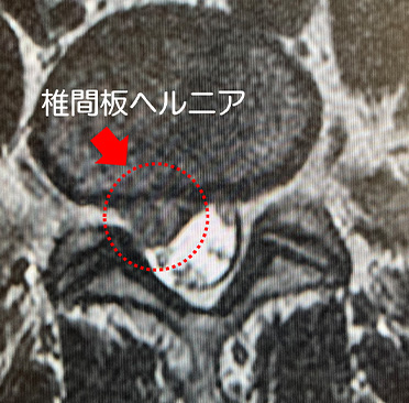 腰椎椎間板ヘルニア に対するFED（写真18）術前MRI