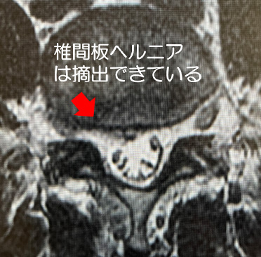 腰椎椎間板ヘルニア に対するFED（写真18）術後MRI