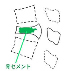 骨セメント