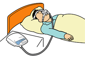 睡眠時無呼吸症候群の治療2