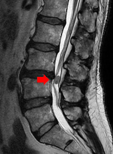 神経鞘腫MRI（写真22）