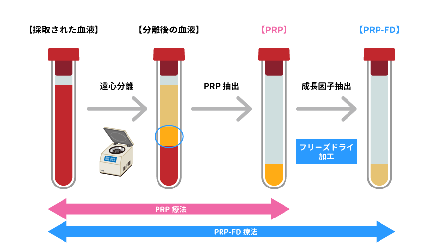 PRP療法とフリーズドライPRP療法